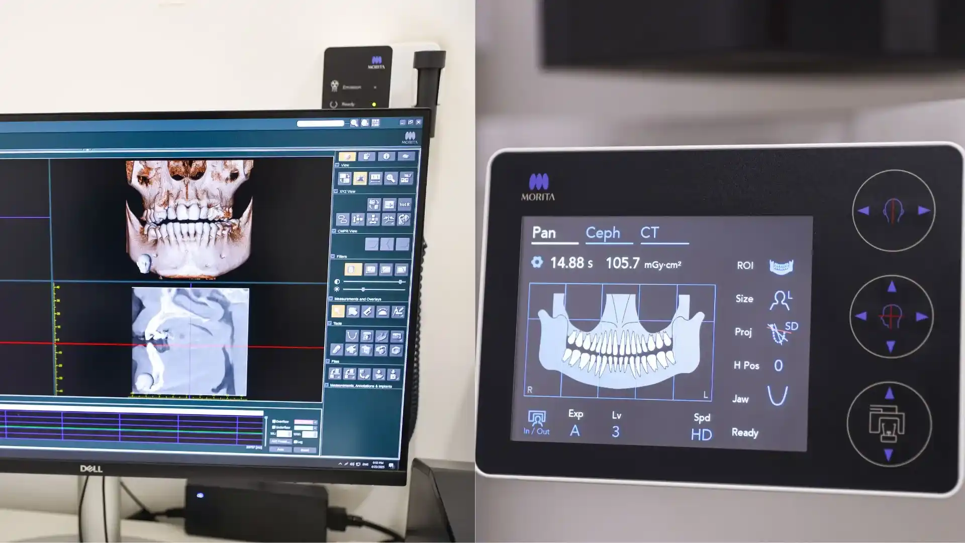 2D панорамный снимок (ОПТГ) и 3D снимок (КЛКТ): отличия и преимущества